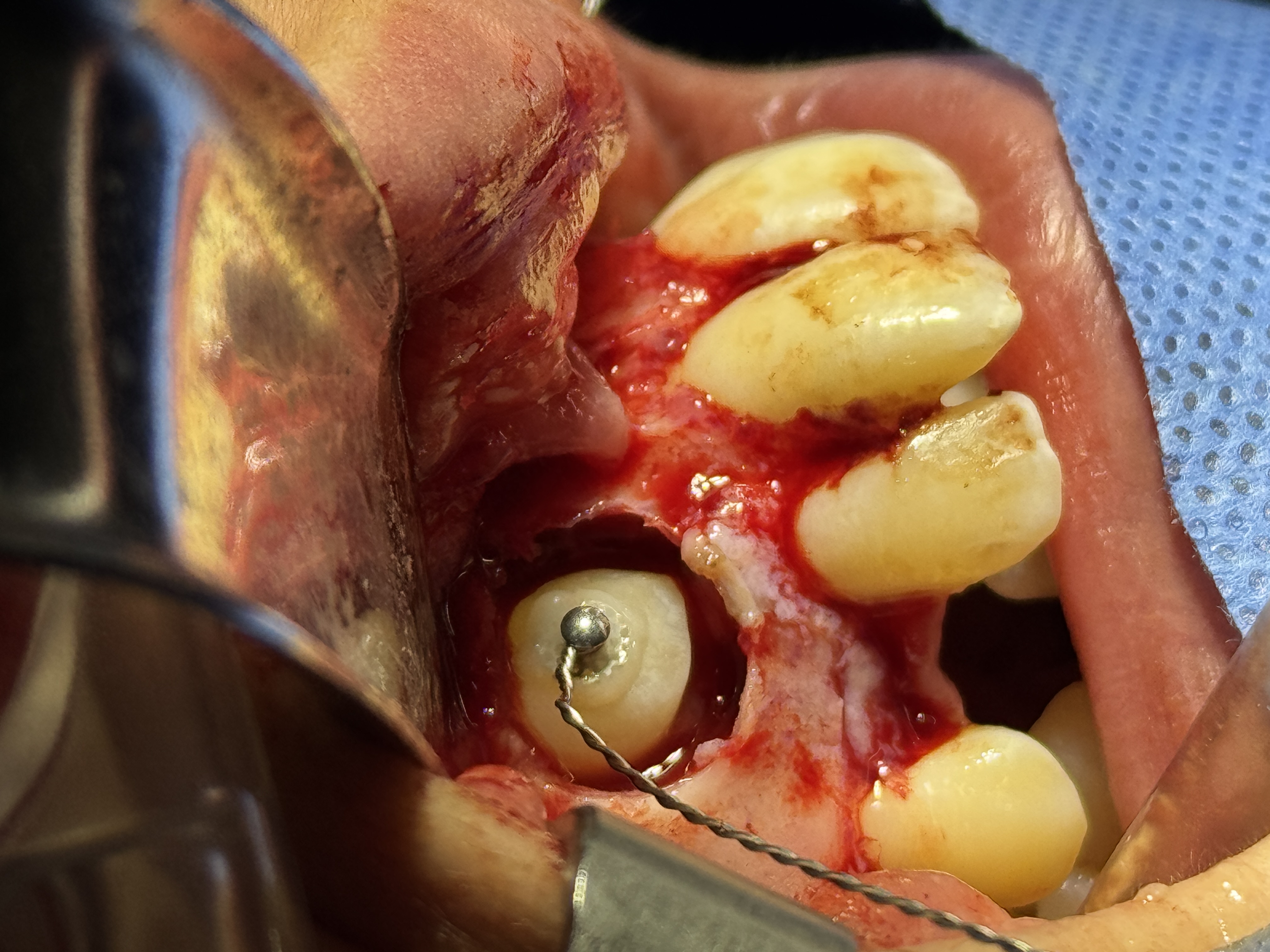 Fenestración canina maxilar